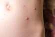 The child has spotted red pimples and a blistering rash from chickenpox or the varicella zoster virus. Viral disease in children. Red pimples all over the body. Infection.

