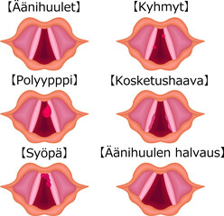 声帯　病気　種類　構造　イラスト　フィンランド語