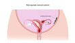 Congenital malformation of uterus that isolates part of the organ and cases retrograde menstruation as one of possible reasons of endometriosis. Vector illustration