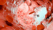 Hemostasis. Red blood cells and platelets in the blood vessel, vasoconstriction, wound healing process. hemorrhage clot embolisms, Hemophilia. fibrinolysis, injury bleeding coagulation, 3d render	
