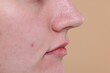 © New Africa - Closeup view of woman with blackheads on her nose against beige background, space for text