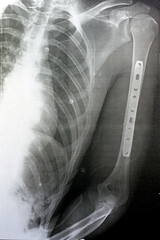 Plain x ray showing transverse midshaft left humerus fracture caused by a direct trauma in a car accident, managed by open reduction and internal fixation with plates and screws, selective focus