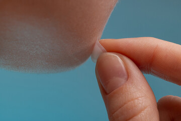 girl with acne stick round acne patch on her cheek. using acne patches for treatment of pimple and r