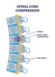 Spinal cord compression with tumor and vertebrae condition outline diagram. Painful back cause with medical problem explanation vector illustration. Skeleton pathology and unhealthy skeletal position