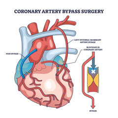 Poster - Coronary artery bypass surgery for blocked blood flow outline diagram. Labeled educational scheme with heart procedure and cardiology condition vector illustration. Medical cardiovascular treatment.