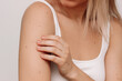 © Марина Демешко - Cropped shot of a young blonde woman with a large number of moles on her arms isolated on a white background. The effect of sunlight on the skin