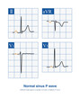 Normal sinus P waves, which may appear as upright, inverted, or biphasic in different leads, depend on the direction of atrial exaltation and the lead axis.