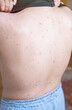 © leroy - Woman back with pimples and black spots close-up