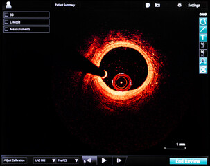 intravascular optical coherence tomography oct image angiography catheter lab atherosclerosis. measurement of coronary artery in cross-sectional and longitudinal view. during cardiac catheterization.