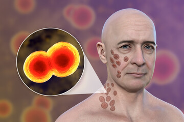 Wall Mural - A man with cutaneous blastomycosis, 3D illustration