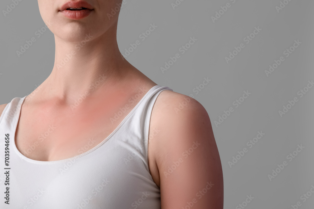 Allergic young woman with sunburned skin on grey background, closeup