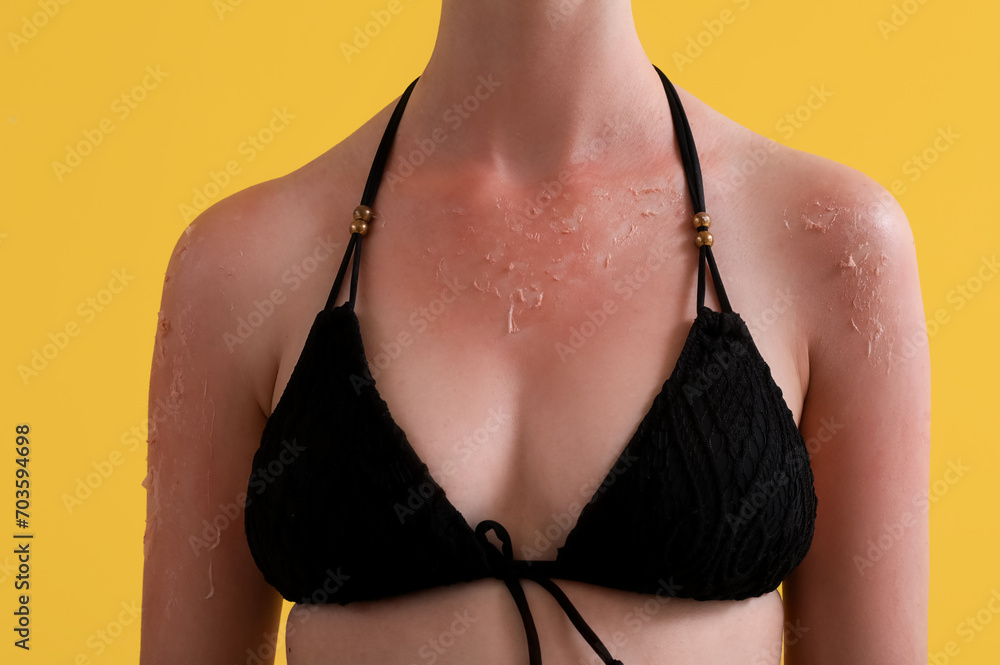 Allergic young woman with sunburned skin on yellow background