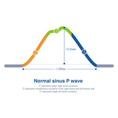 Wall Mural - The illustration shows a normal sinus P wave recorded in a limb lead, with an amplitude of no more than 2.5 mm and a time limit of no more than 110 ms.