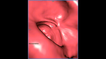 Sticker - CT colonography , This imaging technique is often employed for colorectal cancer screening, providing detailed images of the colon's interior 3D rendering.