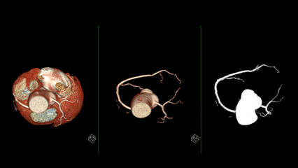 CTA coronary artery 3D rendering is a diagnostic imaging technique capturing detailed visuals of the heart's blood vessels in diagnosing coronary artery diseases and assessing cardiac health.