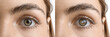 © Pixel-Shot - Closeup view of woman before and after glaucoma treatment on white background