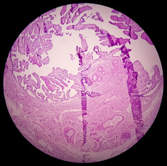 Sticker - Histopathological photomicrograph of ovarian cyst showing Metastatic cystic teratoma.