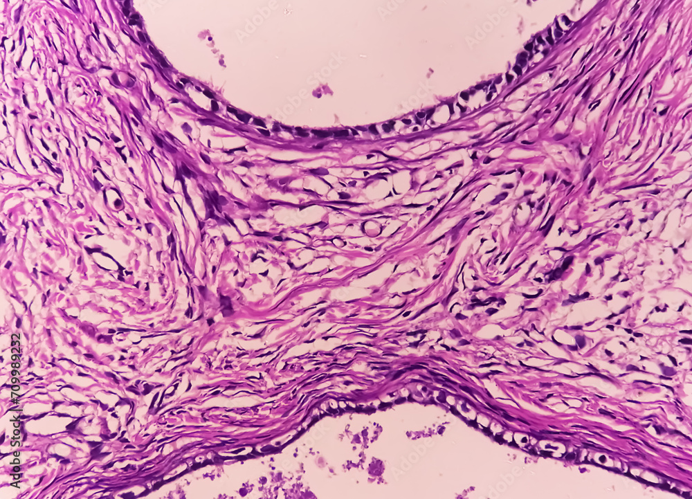 Histology, Peritoneal inclusion cyst. Paraovarian cysts, hydrosalpinx ...