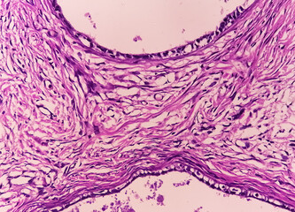 Wall Mural - Histology, Peritoneal inclusion cyst. Paraovarian cysts, hydrosalpinx and low-grade cystic mesothelioma are usually considered in the differential diagnosis of PICs.