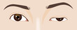 © grafixme - Droopy eyelid ptosis, blepharoplasty symptom, myasthenia gravis, illustration