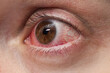 © Katyart - Red eye of a patient with conjunctivitis, close up