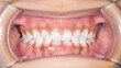 Dental orthodontics case. Front view of a young girl biting teeth. Lips retracted with cheek retractor. A skeletal Class III malocclusion, anterior crossbite retruded maxilla or protruded mandible.