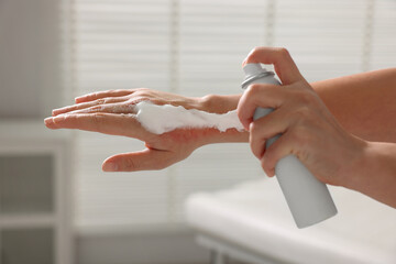 Poster - Woman applying panthenol onto burned hand indoors, closeup