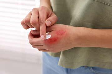 Wall Mural - Woman applying healing cream onto burned hand indoors, closeup