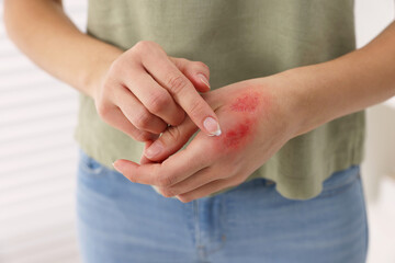 Canvas Print - Woman applying healing cream onto burned hand indoors, closeup