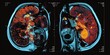 PET-CT fusion images combining PET and CT data for diagnostics