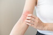 © KMPZZZ - Dermatology asian young woman, girl allergy, allergic reaction from atopic, insect bites on her arm, hand in scratching itchy, itch red spot or rash of skin. Healthcare, treatment of beauty.