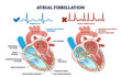 Atrial fibrillation as abnormal heart beat frequency disease outline diagram, transparent background. Labeled educational scheme with cardiovascular condition and heart structure illustration.