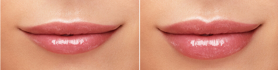 Wall Mural - Female lips correction before and after comparison. Hyaluronic acid injection. Beauty lip treatment procedure.