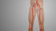 Peripheral artery bypass surgery medical animation