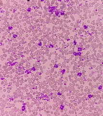 Poster - Essential thrombocytosis blood smear showing abnormal high volume of platelet and White Blood Cells. Panmyelosis. Myeloprokiferative disorder.