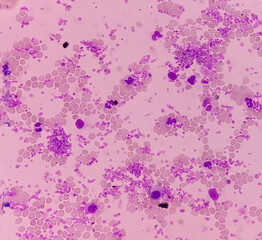 Canvas Print - Essential thrombocytosis blood smear showing abnormal high volume of platelet and White Blood Cells. Panmyelosis. Myeloprokiferative disorder.