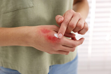 Canvas Print - Woman applying healing cream onto burned hand indoors, closeup