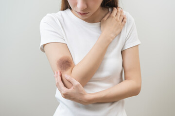 Wall Mural - Close up of stain bruise wound on her arm, contusion asian young woman, girl an accident fell down stairs at home, hand in healing injury by massage hematoma blood. Extravasation blue, purple on skin.