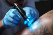 © Rojo - A boy removes a tattoo from his back with laser treatment