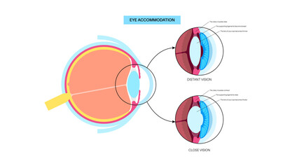 Sticker - Eye accommodation poster