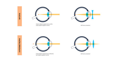 Wall Mural - Astigmatism eye disease