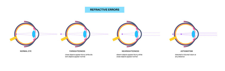 Wall Mural - Refractive errors poster