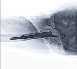 Wall Mural - An X-ray reveals both hip joints with hemiarthroplasty, showcasing the success of the surgical procedure and providing a visual testament to the restored mobility and function.