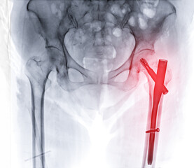 Wall Mural - An X-ray reveals both hip joints with hemiarthroplasty, showcasing the success of the surgical procedure and providing a visual testament to the restored mobility and function.