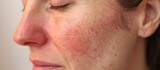 Fototapeta  - After successful rosacea treatment on a Caucasian woman's face, laser surgery removes redness and visible blood vessels.