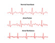 Diagram of normal rhythm, Atrial flutter and Atrial fibrillation for a human heart. Heart cardiogram. Vector illustration in flat style isolated on white background