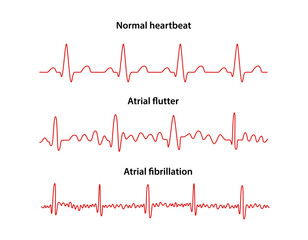 Diagram of normal rhythm, Atrial flutter and Atrial fibrillation for a human heart. Heart cardiogram. Vector illustration in flat style isolated on white background