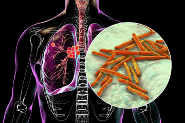 Poster - Primary lung tuberculosis, 3D illustration