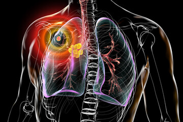 Canvas Print - Primary lung tuberculosis, 3D illustration