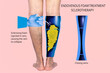 © Solarisys - Endovenous laser treatment for varicose veins - foam sclerotherapy concept.